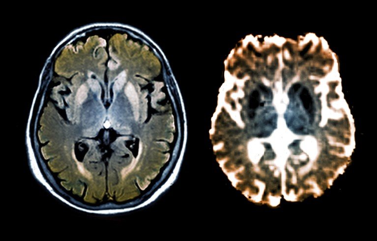 Imagen compuesta de escáneres de resonancia magnética FLAIR y de difusión del cerebro de un paciente de 47 años, mostrando hiperintensidades alrededor del área de la corteza y los ganglios basales, sugestivas de