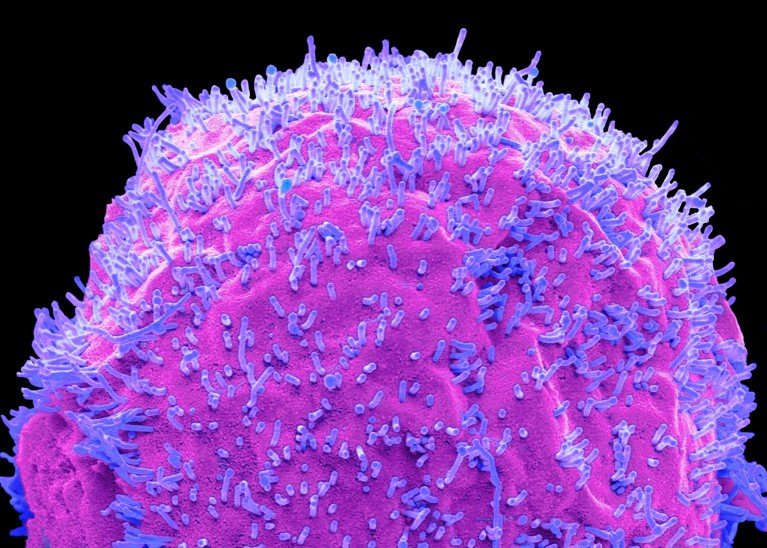 Micrografía electrónica de barrido en colores de células humanas infectadas con virus de gripe aviar, representadas en colores rosados y púrpuras