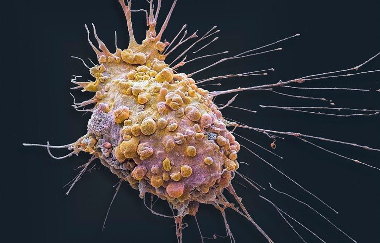 Micrografía electrónica de una célula cancerosa de oligodendroglioma.